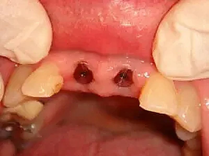 Implant dentaire avant traitement — réhabilitation sur implants, Bruxelles